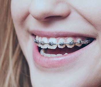 Metal Braces Metal Braces