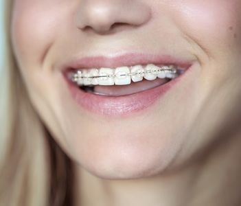 Ceramic braces Ceramic braces