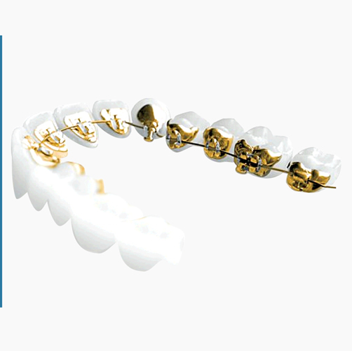 How do lingual braces work? How do lingual braces work?