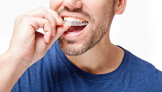 Spark Aligners Spark Aligners