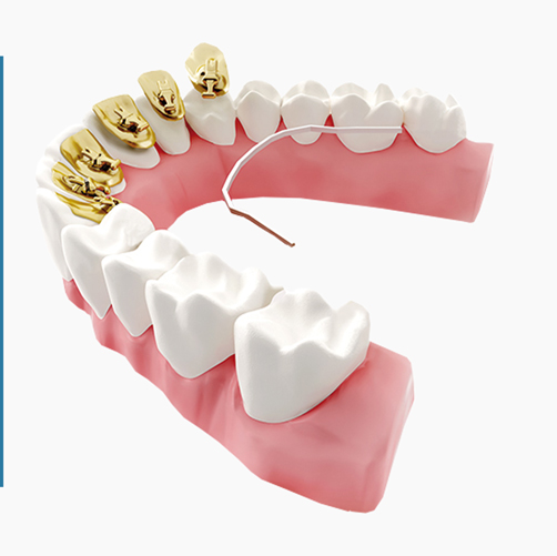 Who are lingual braces for? Who are lingual braces for?